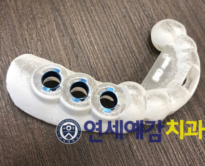 시청역 연세예감치과 디지털임플란트우수시술병원 선정 & 네비게이션 임플란트 관련 이미지 6