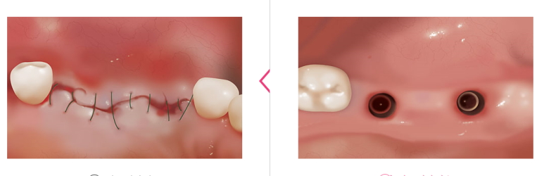 시청역 광화문  최소절개 또는 비절개로 가능한 네비게이션 임플란트 유명한 치과 내비게이션소개드려요 관련 이미지 3