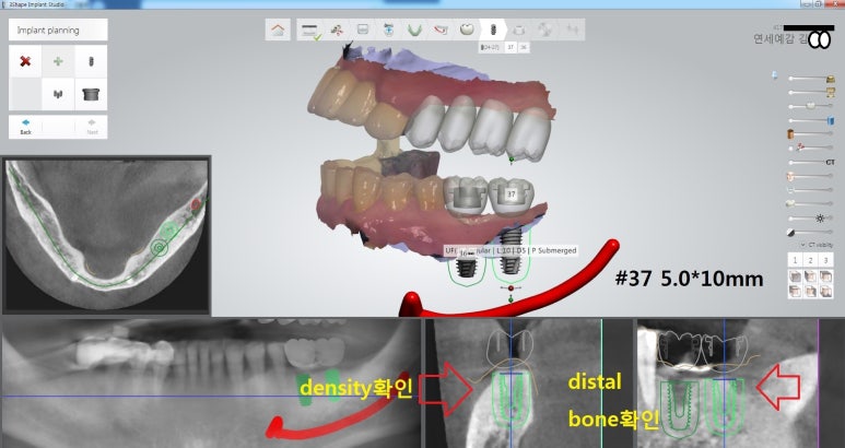 시청역 광화문  최소절개 또는 비절개로 가능한 네비게이션 임플란트 유명한 치과 내비게이션소개드려요 관련 이미지 11