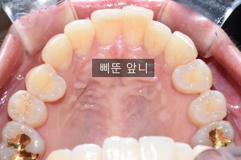 오래전 교정한 치아가 틀어져서 부분 재교정 케이스, 비용가격[광화문/서울역/치과] 관련 이미지 2