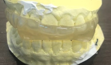 [서울] 이갈이보톡스, 이갈이장치, 턱관절 보톡스,사각턱 보톡스, 관자놀이보톡스 안내 관련 이미지 3