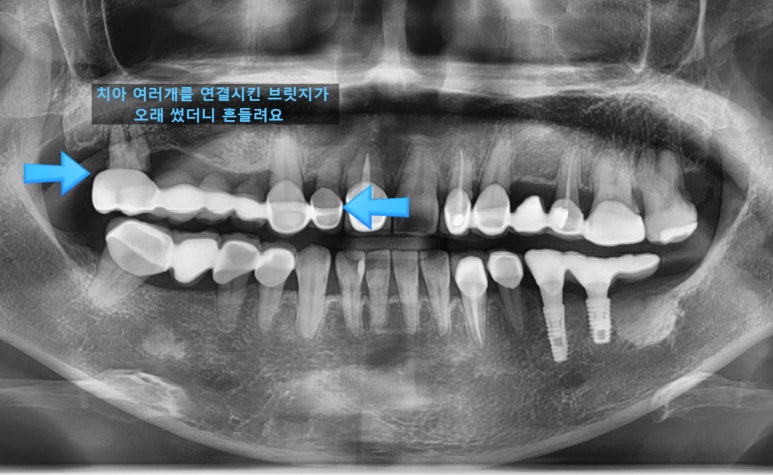 충정로 서울역 근처 고난도 & 재수술 임플란트 수술 치과 관련 이미지 13