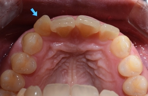 [시청역/광화문/서대문]삐뚤삐뚤한 치아 무삭제라미네이트로 치아성형 관련 이미지 4