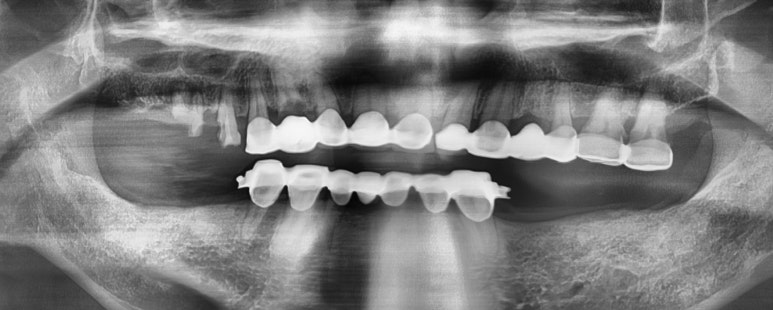 남대문시장&시청역가까운 치과/보험틀니 환자분 스토리 소개 관련 이미지 2