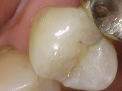 광화문 시청치과 치아가 쪼개졌어요 실제사례 관련 이미지 1