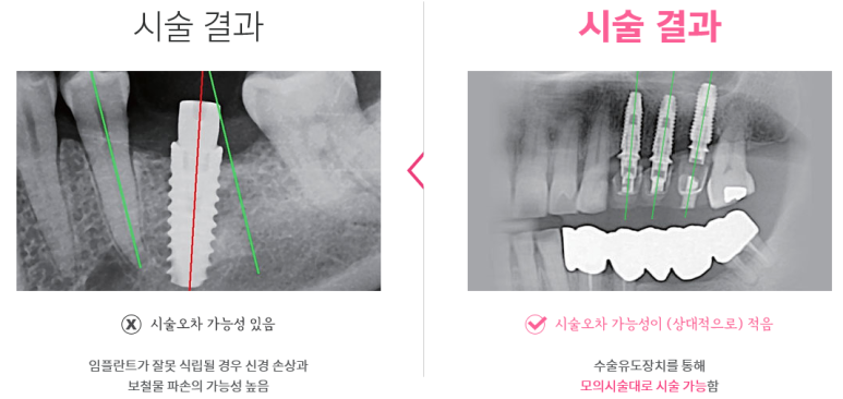 [서울시청역치과] 20대, 30대도 임플란트를 하나요?? +네비게이션임플란트안내 관련 이미지 6