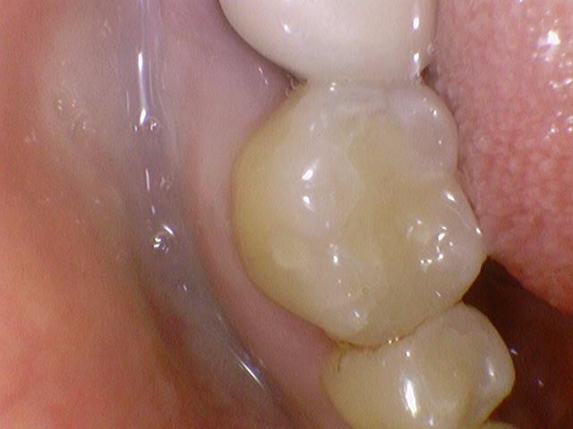 서울 인레이 유명한 치과 서울시청역치과 인레이에 대해 안내해드려요 관련 이미지 3