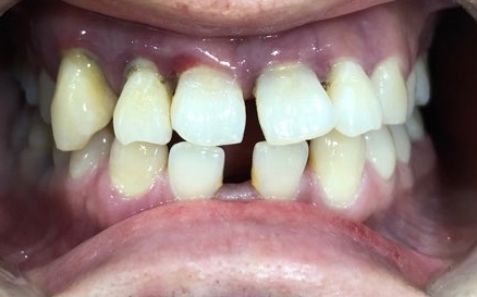 시청역치과 벌어진 앞니를 바르고 이쁘게! 대한심미학회회원치과 관련 이미지 3