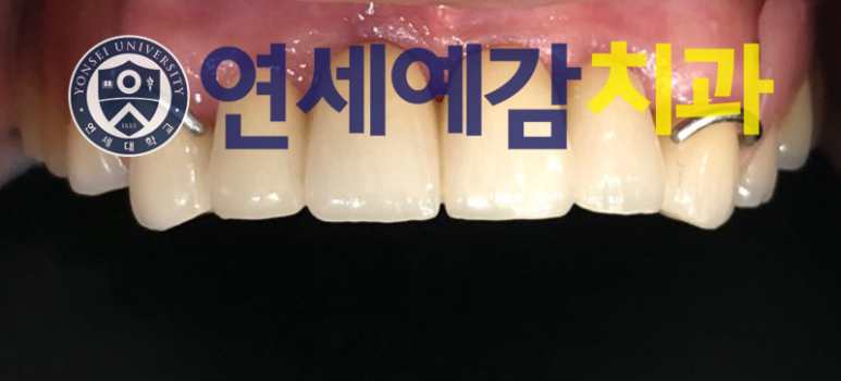 서울 틀니제작, 틀니치료 실제 예입니다. 시청역<연세예감치과> 관련 이미지 13