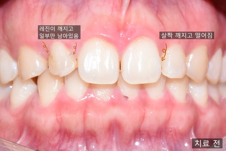 [서울/시청역] 양쪽 두 개 왜소치 오래된 레진 떨어져서 라미네이트 한 케이스(+라미네이트 가격) 관련 이미지 3