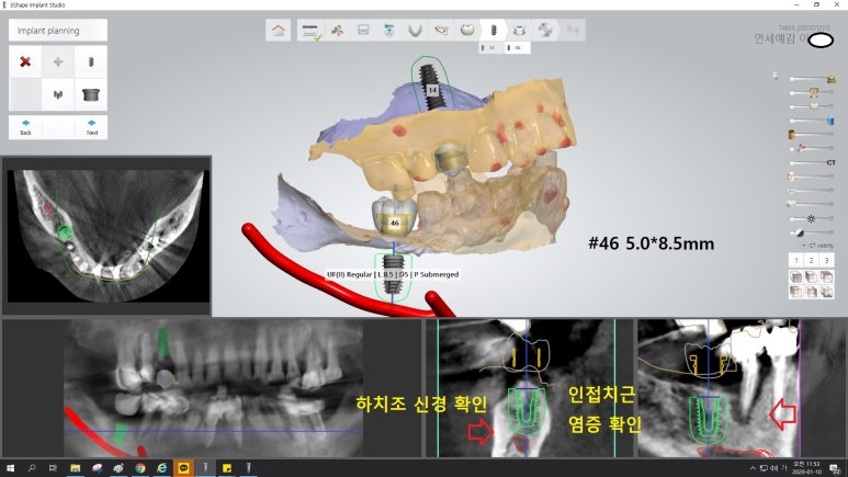 [북창동 치과/연세예감치과]내비게이션임플란트소개 관련 이미지 7