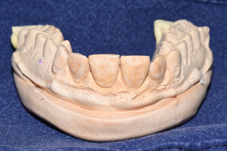 [서울역/을지로/치과] 본인이 옥니라고 생각한다면? 무삭제 라미네이트 어떤가요? 케이스 및 가격비용 관련 이미지 3