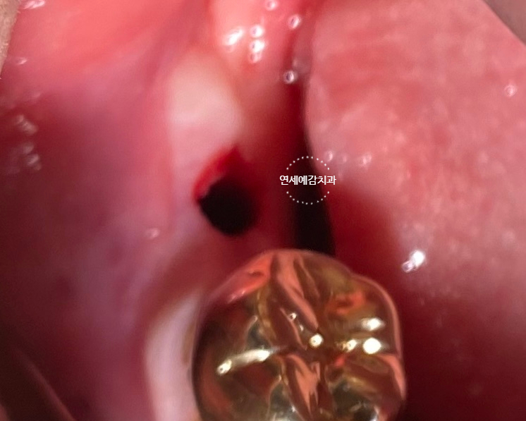 남대문시장 근처 치과 임플란트 연세.예감.치과 관련 이미지 14