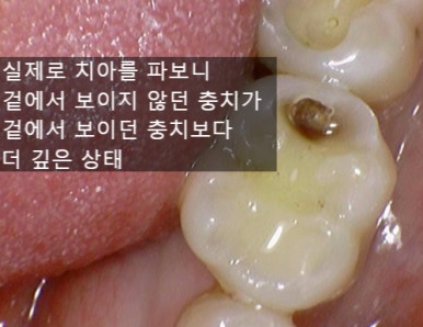 시청역 충정로 충치치료 치과 추천 관련 이미지 4