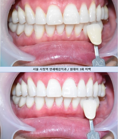 소개팅준비? 결혼 준비? 외국,해외에서도 찾아오는 치아미백 치과! 관련 이미지 15