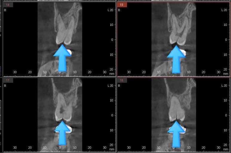 광화문 시청치과 치아가 쪼개졌어요 실제사례 관련 이미지 7