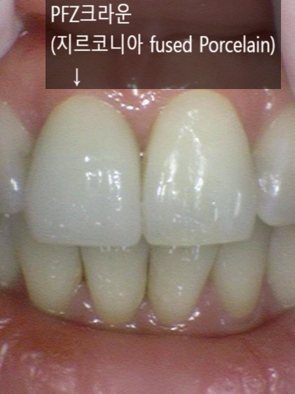 해외에서도 찾아오는 [시청역 연세예감치과]에서 알려드리는 지르코니아크라운 관련 이미지 6