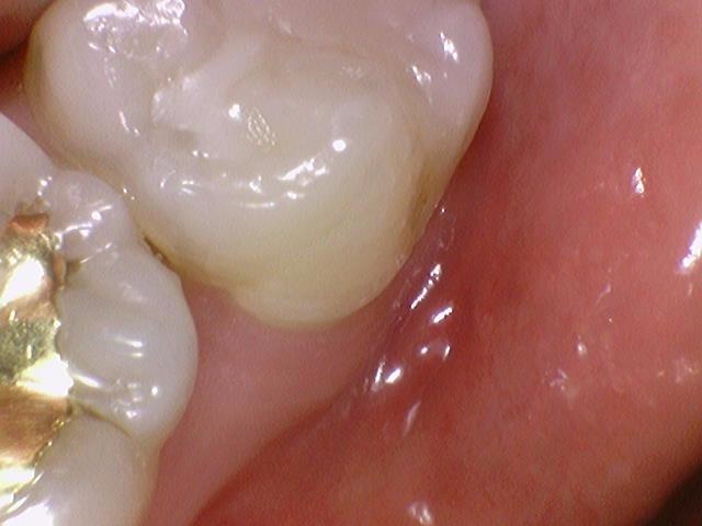 보여주는 충치치료, 믿고 치료받으세요. 서울시에서도 인증한 해외에서도 찾아오는 시청역치과 관련 이미지 3