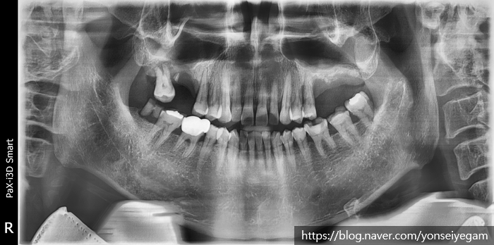 [서울시청역/남대문]어금니임플란트+상악동거상술(뼈이식):실제케이스 관련 이미지 1