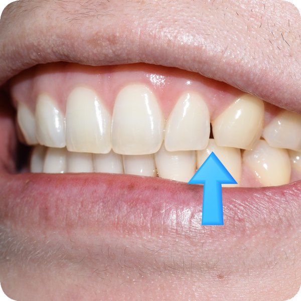 (교정 후에도) 벌어진 앞니 치아 레진으로 간단히 메꾸기 관련 이미지 4