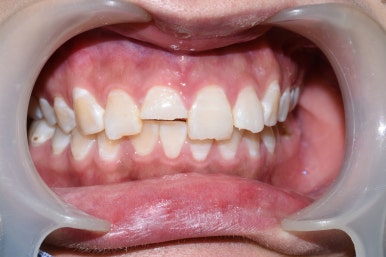 깨진 치아 레진치료 방법 실제사진 관련 이미지 8