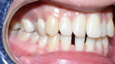 "아래 앞니 벌어진 틈 레진 하고 싶어요" &rarr;치료후 "(감쪽같아서) 어디를 했는지 모르겠어요" 관련 이미지 3