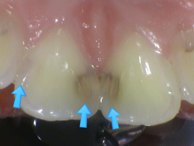 앞니충치가 너무 심해요 앞니 충치치료 방법 [시청역서울역 치과] 관련 이미지 4
