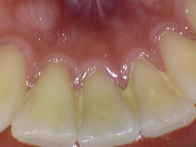 [충정로] 스케일링 흔히 질문하시는 부분에 대한 질문과 답변 Q&A 관련 이미지 1