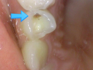 [서울시청역] 눈에 보이지 않는 충치 실제사진 관련 이미지 10