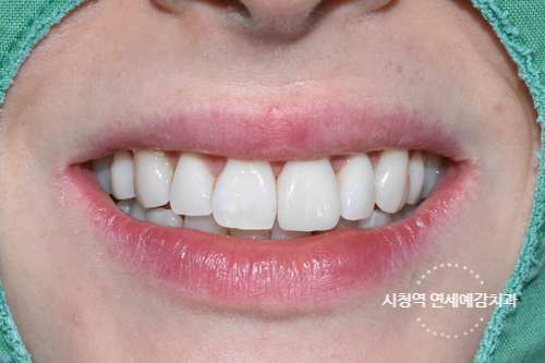 시청역 치과/ 신경이 죽은 치아의 변색 치료 위한 크라운 케이스&가격도 / 외국인 환자분이 눈물을 흘리셨어요 관련 이미지 4