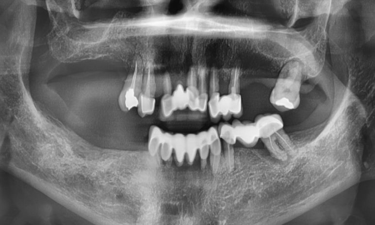 전체 임프란트를 하기 위해 홍콩에서 오신 홍콩인 환자분 관련 이미지 1