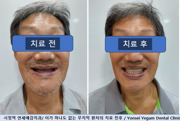 서울 중구 치과/이가 하나도 없는 환자의 치료방법/틀니, 풀아치임플란트, 전체 임플란트 등 관련 이미지 1