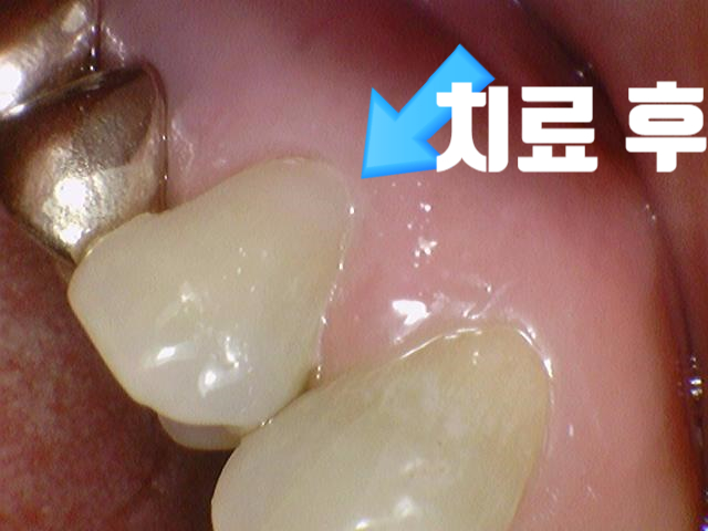 쓰읍하고 바람 들이킬 때마다 이가 시려요 케이스 관련 이미지 6