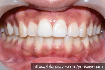[시청역 치과]앞니가 튀어나왔어요&부러졌어요 ->앞니를 바르고 예쁘게,앞니 크라운 관련 이미지 3