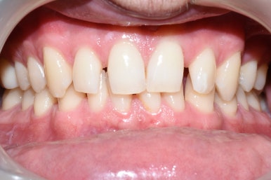 서울시청역치과/ 벌어진 앞니 치아 치료/ 왜소치, 다이아스테마 등/레진, 라미네이트, 부분교정 비교 관련 이미지 17