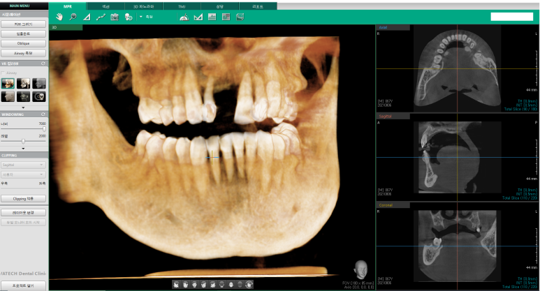 [서울시청역/서울역] 앞니 임플란트 가능할까요? 앞니 내비게이션임플란트 관련 이미지 5