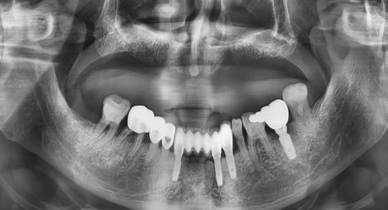 [남대문] 치과임플란트 조금더 덜아프고, 간단하게! 관련 이미지 5