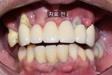 앞니 여러개 임플란트 잘하는 치과 서울역치과 실제사진 관련 이미지 18