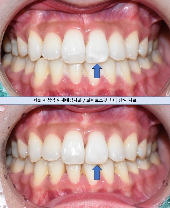반상치 화이트스팟 외국인들도 치료받으러 오는 광화문 연세예감치과 관련 이미지 3