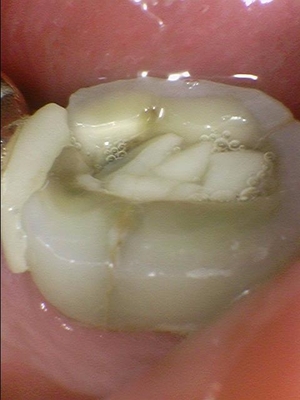 연세예감치과에서 알려드리는 심미적이고 기능적으로도 우수한 e-max인레이 치료 관련 이미지 3