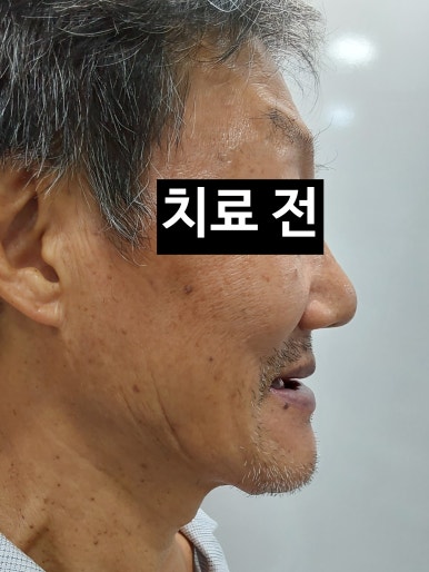 서울 중구 치과/이가 하나도 없는 환자의 치료방법/틀니, 풀아치임플란트, 전체 임플란트 등 관련 이미지 4