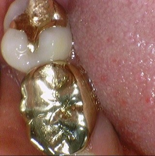 시청역치과/ 연세예감치과에서 "지르코니아 크라운" 알려드려요 관련 이미지 4