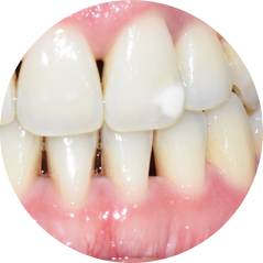 반점치, 반상치, 치아에 하얀 점 치료방법 전후사진, 가격 비용까지 관련 이미지 1