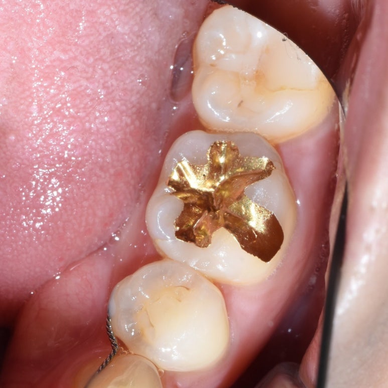 [을지로/치과] 하얀색 이맥스 인레이 세라믹인레이 / 실제 케이스/ 비용 가격 알려드려요 관련 이미지 3