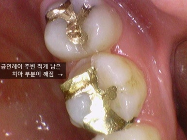 [서울/시청역]어금니 치아가 깨져서 크라운이 필요하다면? 관련 이미지 1