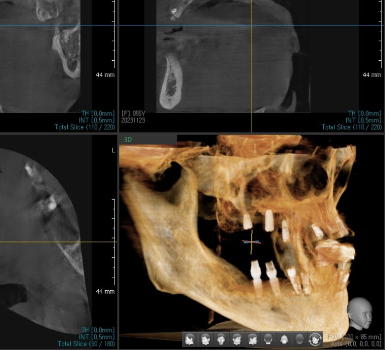 전체 임프란트를 하기 위해 홍콩에서 오신 홍콩인 환자분 관련 이미지 3