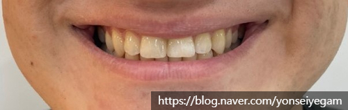 앞니가 벌어진 치아치료 사례: 라미네이트(치아삭제없는 무삭제프리네이트) 관련 이미지 4