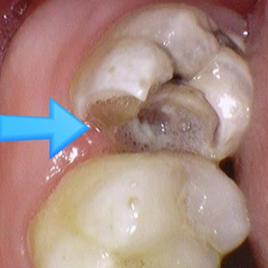 [서울시청역] 눈에 보이지 않는 충치 실제사진 관련 이미지 4