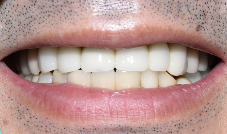 앞니 여러개 임플란트 잘하는 치과 서울역치과 실제사진 관련 이미지 20