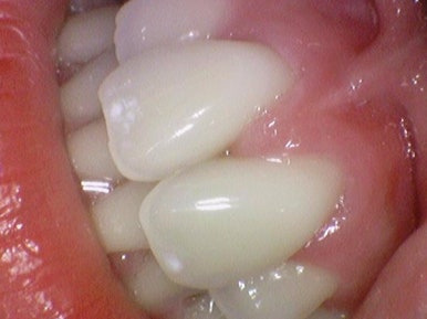 서울시청역 앞니 치아에 갈색 점, 흰색점 치료 전후 관련 이미지 10